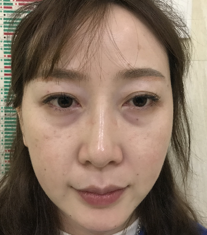 去眼袋手术