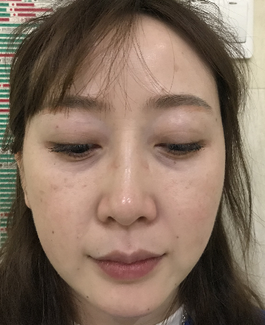 去眼袋手术