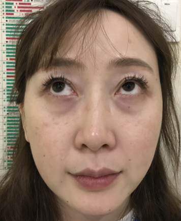 去眼袋手术