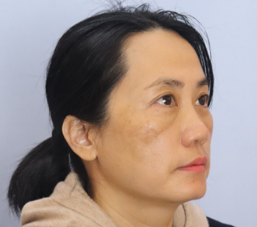 去眼袋手术
