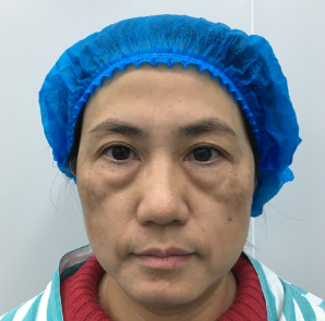 去眼袋手术