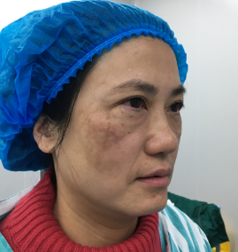 去眼袋手术
