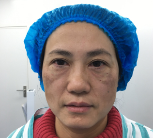 去眼袋手术