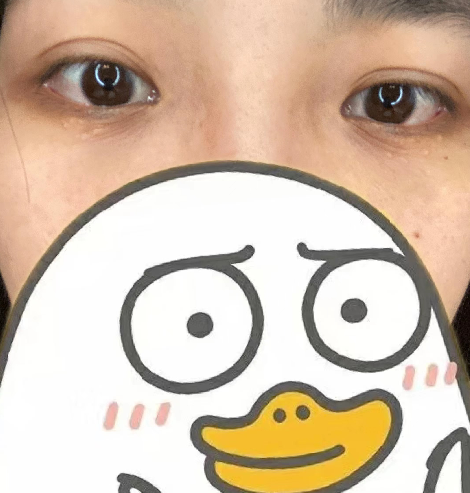 去眼袋手术
