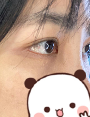 去眼袋手术