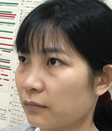 去眼袋手术