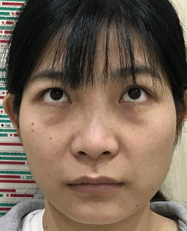 去眼袋手术