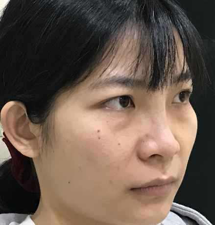 去眼袋手术