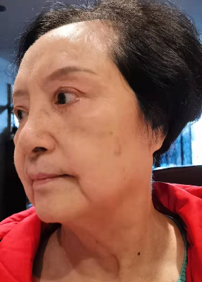 去眼袋手术