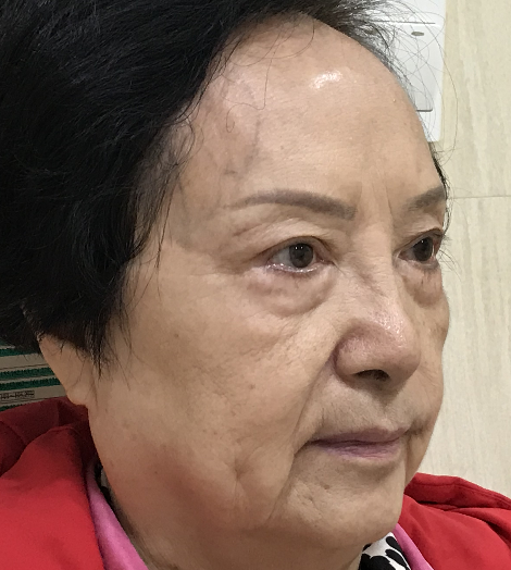 去眼袋手术