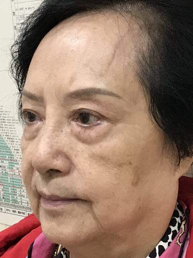 去眼袋手术