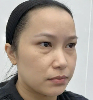 去眼袋手术