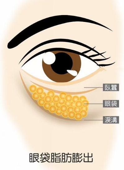 去眼袋手术