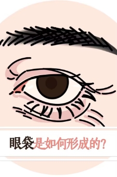 去眼袋手术