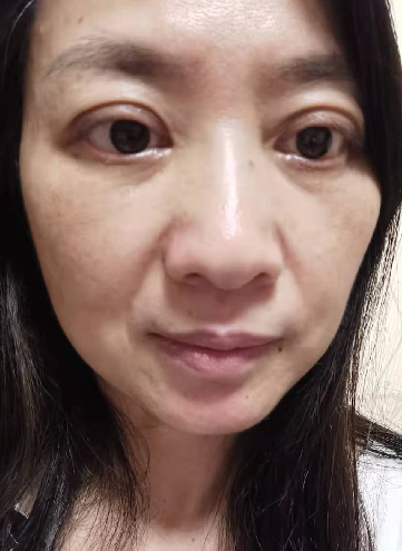 去眼袋手术