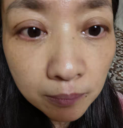 去眼袋手术