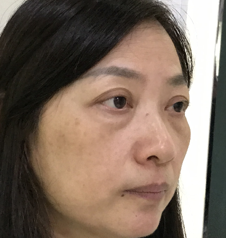 去眼袋手术
