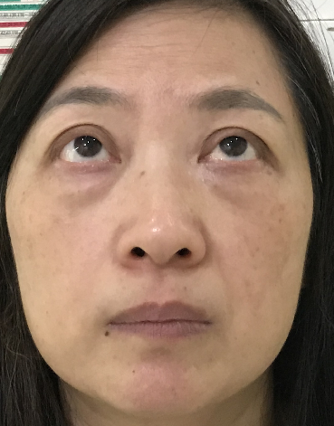 去眼袋手术