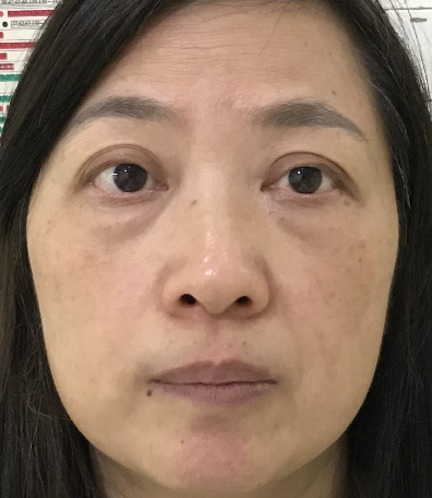 去眼袋手术