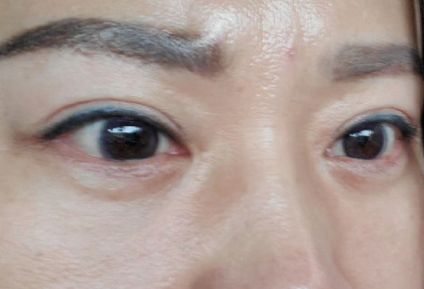 去眼袋手术