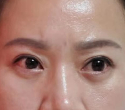 去眼袋手术