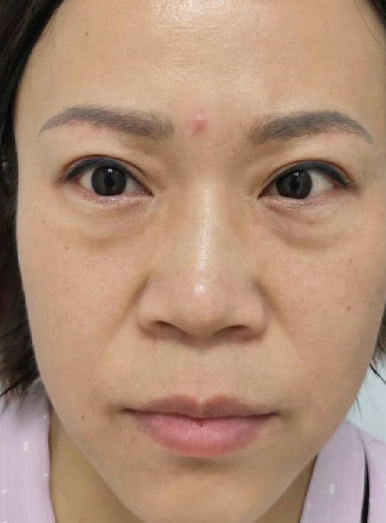 去眼袋手术