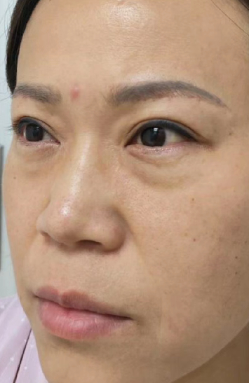 去眼袋手术