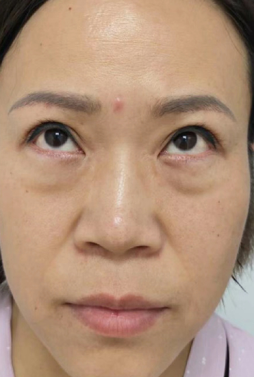 去眼袋手术