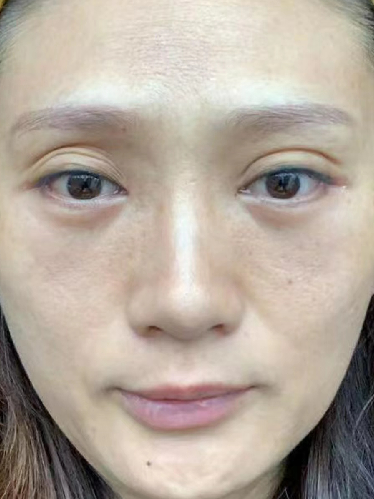 去眼袋手术