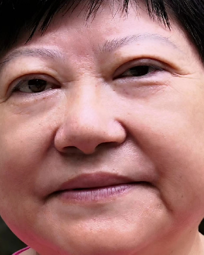双眼皮手术