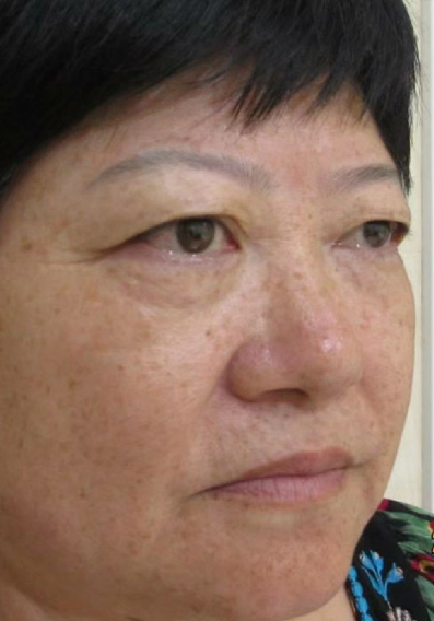 双眼皮手术