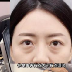 眼袋