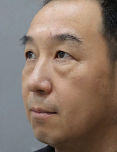 去眼袋手术