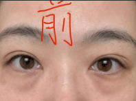 去眼袋手术