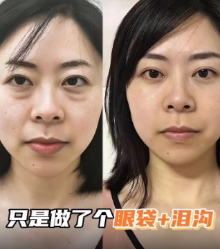 去眼袋手术