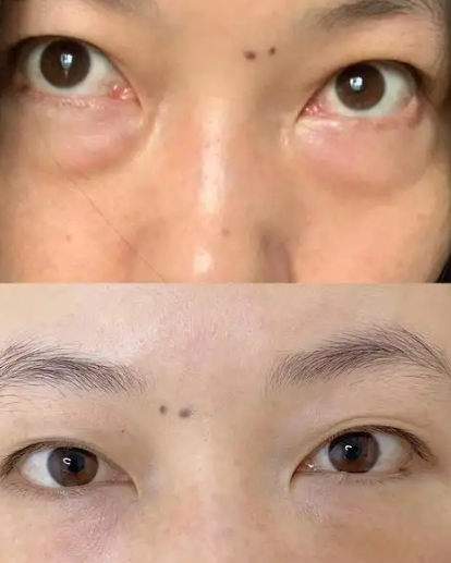 去眼袋手术