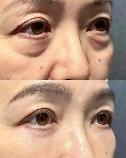 眼袋