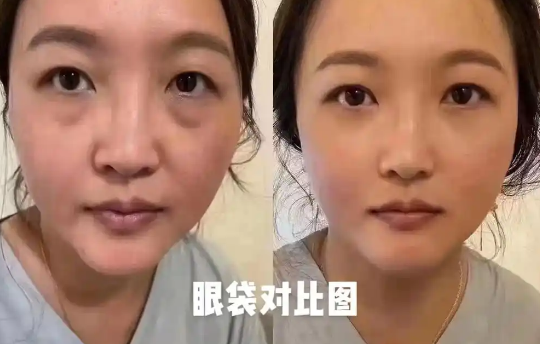 眼袋