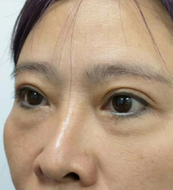 去眼袋手术