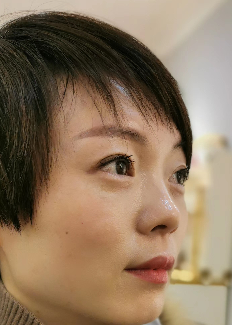 去眼袋手术