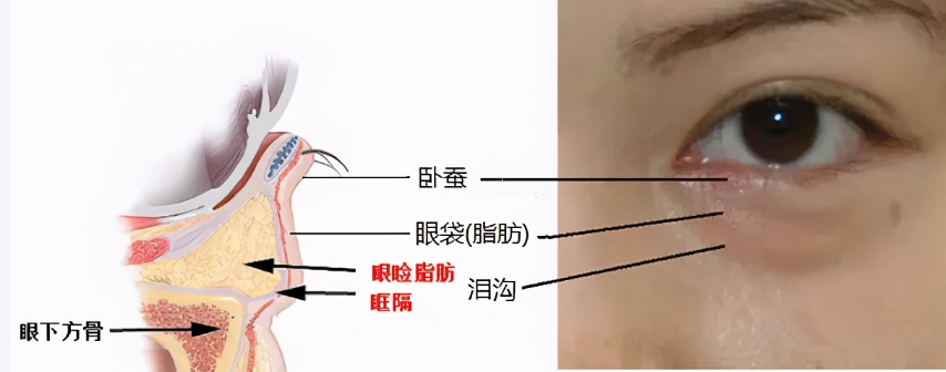 去眼袋手术