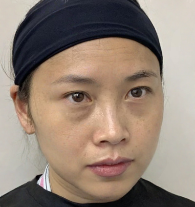 去眼袋手术