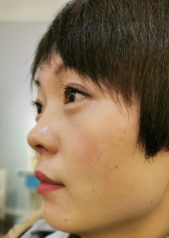 去眼袋手术