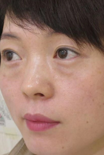 去眼袋手术