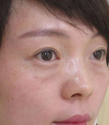 去眼袋手术