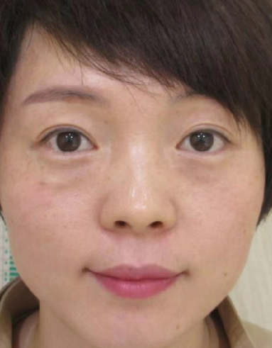 去眼袋手术