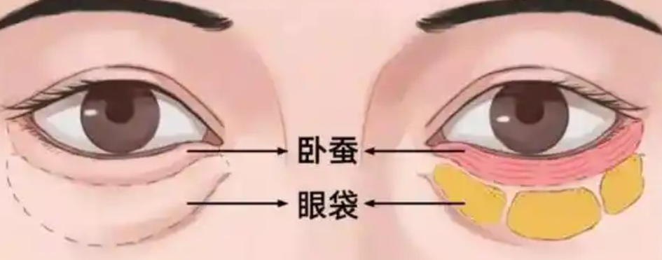 眼袋