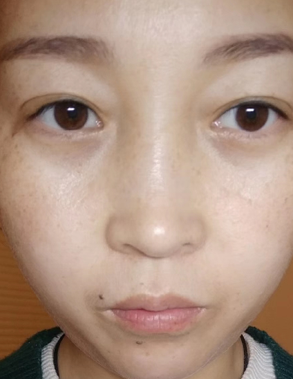 眼袋