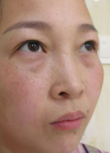眼袋