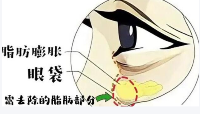 眼袋